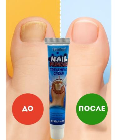 OLBY Miracle remedy for nail fungus on the arms and legs 5 pieces - Buy Online on GoSupps.com