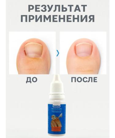 mua Remedy for restoring ingrown nails without pain 3pcs