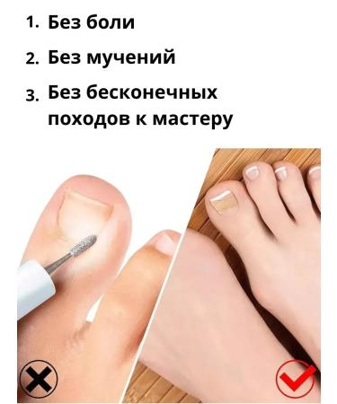 Bilioner remedy for ingrown nails patch from ingrown nails - Buy Online on GoSupps.com