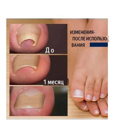 datka7 From an ingrown nail a patch-roperator from a fingers on the finger - Buy Online on GoSupps.com