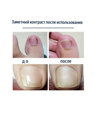 datka7 Stifflays from ingrown nails and nail fungus 50pcs - Buy Online on GoSupps.com