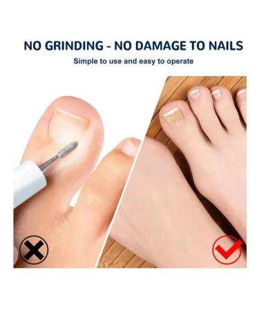 Janar brands Patch from an ingrown nail and fungus strips for correction - Buy Online on GoSupps.com