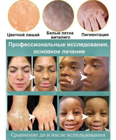 Vitiligo cream treatment efficiently removes white spots - Buy Online on GoSupps.com