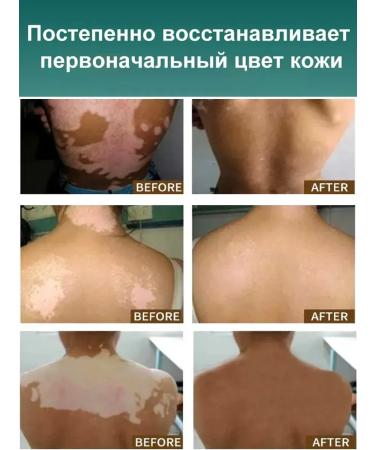 Vitiligo cream treatment efficiently removes white spots - Buy Online on GoSupps.com