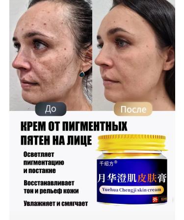 Cream for whitening and removing pigmentation