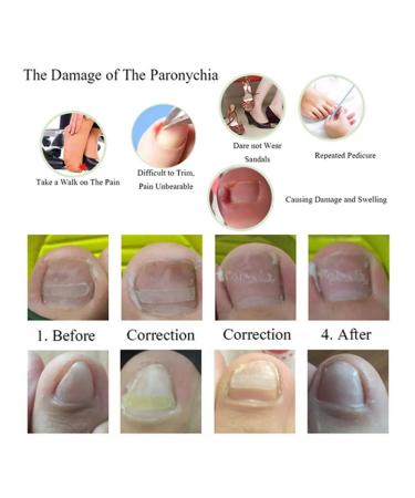 Clip for aligning the ingrown nail + File glue - Buy Online on GoSupps.com