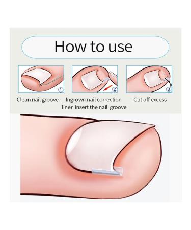 Corner corrector C-shaped health for feet (02) - Buy Online on GoSupps.com