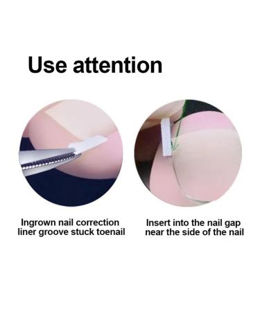 Corner corrector C-shaped health for feet (02) - Buy Online on GoSupps.com