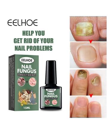 Fly for the treatment of nail fungus 15ml nail recovery - Buy Online on GoSupps.com