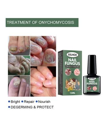 Fly for the treatment of nail fungus 15ml nail recovery - Buy Online on GoSupps.com