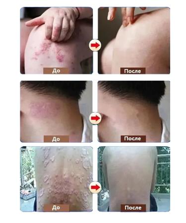 Itching cream is relieved of bacterial infections 20 g - Buy Online on GoSupps.com