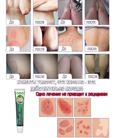 Itching cream is relieved of bacterial infections 20 g - Buy Online on GoSupps.com