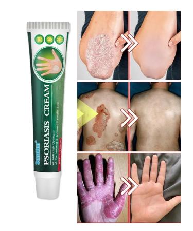 Itching cream is relieved of bacterial infections 20 g - Buy Online on GoSupps.com