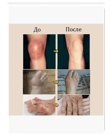 An ointment anesthetic from gout on the legs 110r - Buy Online on GoSupps.com