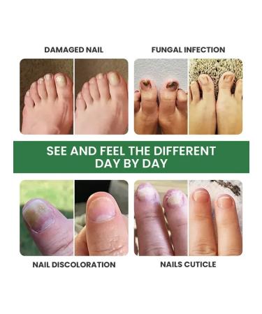 KazBrand Nail fungus cream ointment to remove fungus on nails - Buy Online on GoSupps.com