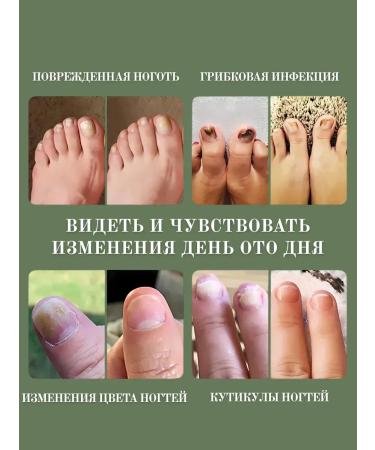 Barynch Nail fungus cream antifungol with onycholysis - Buy Online on GoSupps.com