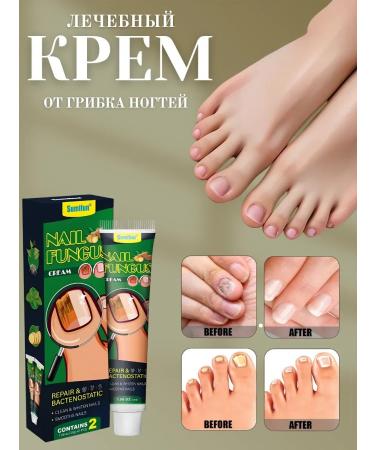 Barynch Anti -fowngal with onycholse cream from Nail Fungus nail fungus