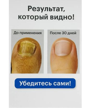 Kirunya Nail fungus cream - Buy Online on GoSupps.com