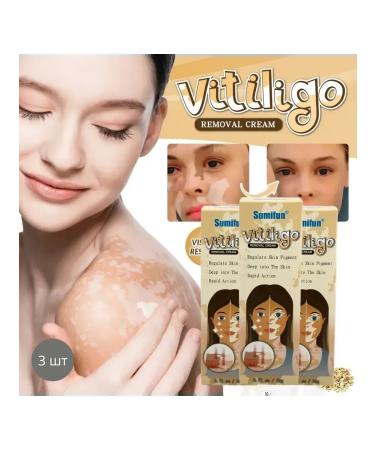 MaxWish 09 Cream for removing freckles and pigment spots of vitiligo 3pcs