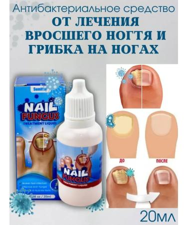 New suite Chinese remedy for nail fungus
