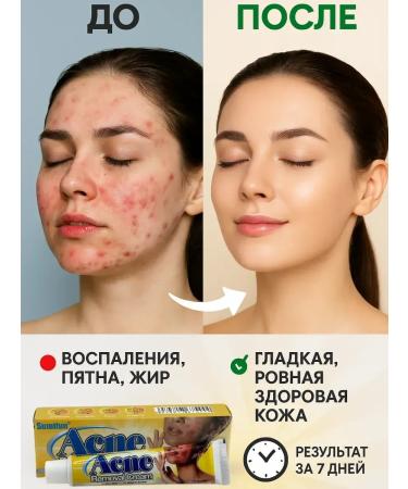 OLBY Acne cream and acne on the face for problem skin 5 pieces - Buy Online on GoSupps.com