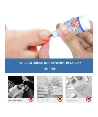 MaxWish 09 Antibacterial fluid for the treatment of ingrown nails 1 pcs - Buy Online on GoSupps.com