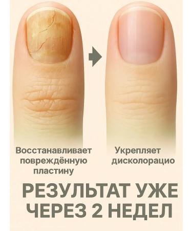 COME Medicated nail cream - Buy Online on GoSupps.com