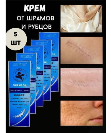 Kalis Cream ointment for removing scars and scars