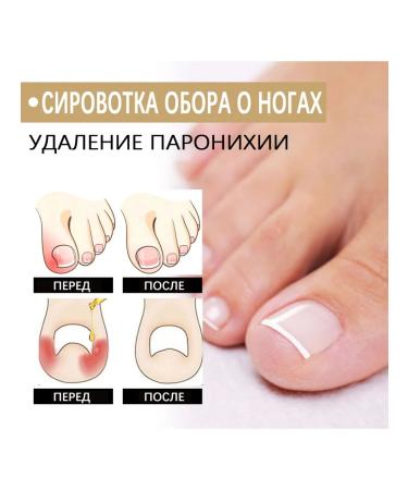 Repair essence for treats ingrown nails and fungal infections - Buy Online on GoSupps.com