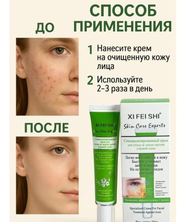 sps2 Acne cream and face - Buy Online on GoSupps.com