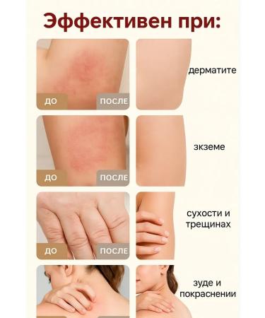 sps2 Itching cream and skin inflammation with eczema and dermatitis - Buy Online on GoSupps.com