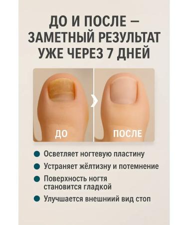 Teon Nail fungus cream set 3 pcs - Buy Online on GoSupps.com