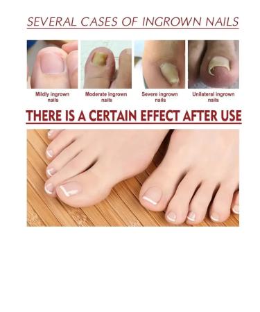 Dona7 Oil for ingrown toenails - Buy Online on GoSupps.com