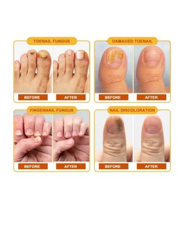 zoomba Nail fungus cream 5pcs - Buy Online on GoSupps.com