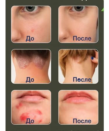 PatiMari Cream from seborrheic dermatitis of itching and from the fungus on the head - Buy Online on GoSupps.com