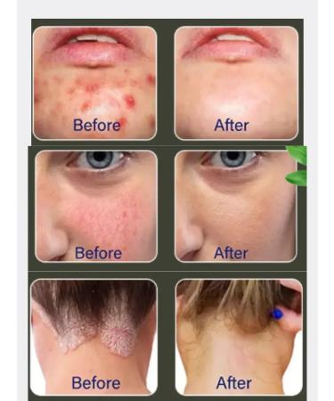 SoSo Dermatitis cream - Buy Online on GoSupps.com