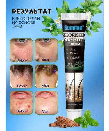 Kamielli Cream ointment from seborrheic dermatitis on the head 3 pieces - Buy Online on GoSupps.com