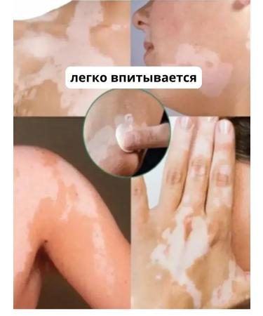 AZHAR Vitiligo cream and pigment spots set 3pcs - Buy Online on GoSupps.com