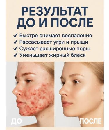 Teon Ointment from acne and inflammation acne control 1 pcs - Buy Online on GoSupps.com