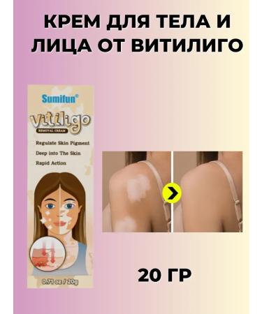DavidSon2017 Vitiligo cream
