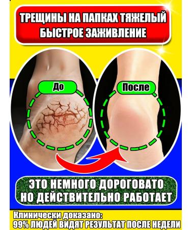 Cream for the legs with urea from cracks