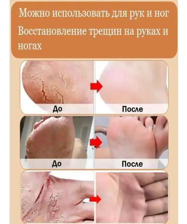 Cream for the legs with urea from cracks - Buy Online on GoSupps.com