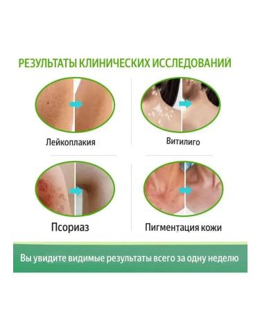 VALLEY Vitiligo face gel cream gel - Buy Online on GoSupps.com