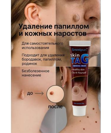 Dubai luxury Cream for papillomas and skin growths