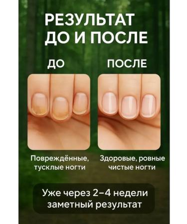 MILINABOSS Remedy for nail fungus eliminates darkening and itching 1pc - Buy Online on GoSupps.com