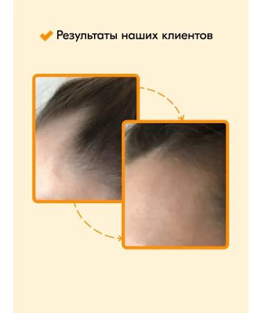 Zhangguang 101 Hair growth Lotion Acts against falling out and baldness - Buy Online on GoSupps.com