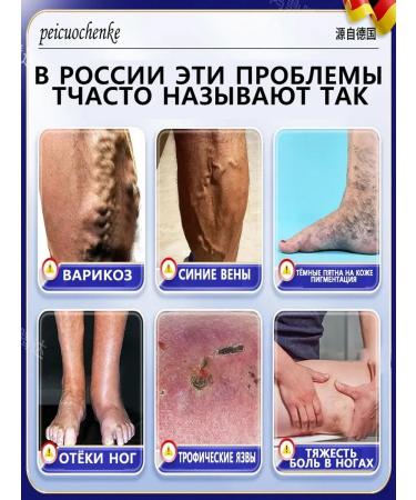 Gel from varicose veins on the legs of Chinese 50 g - Buy Online on GoSupps.com