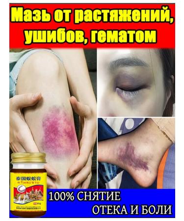 Ointment from bruises and sprains with anesthetic 165 ml