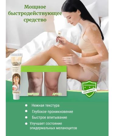 VALLEY Vitiligo cream for the body of the legs and arms cream against pigmentation - Buy Online on GoSupps.com
