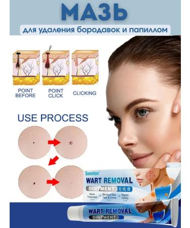 Welcome 1 Cream for removing warts and papilloma celandine